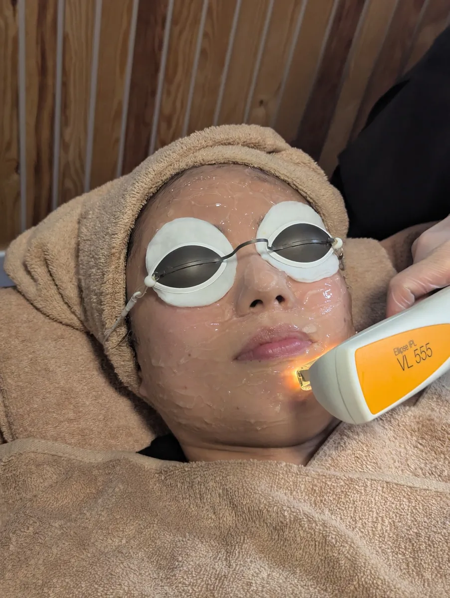 IPL treatment